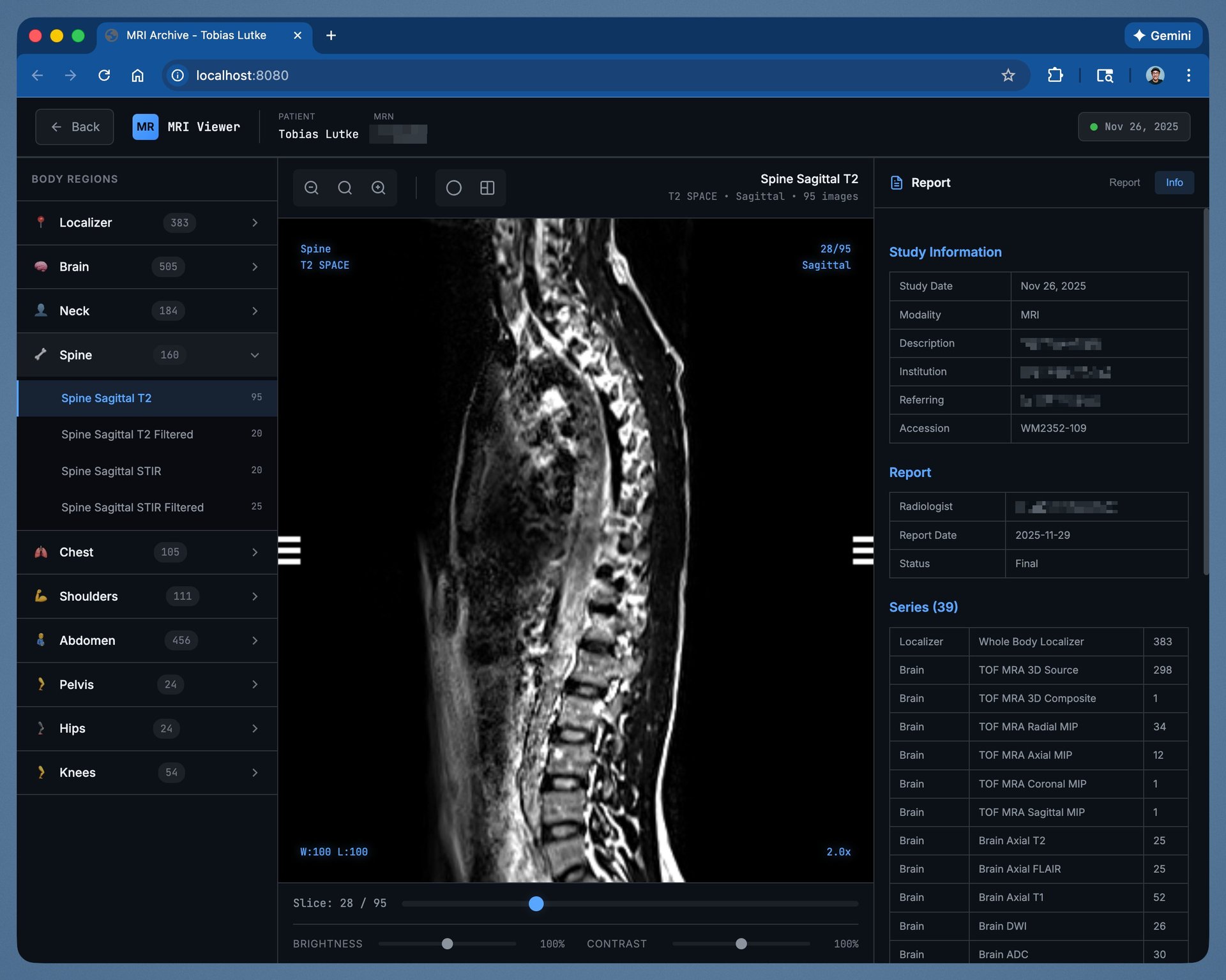 Browser-based MRI viewer showing spine scan, illustrating AI-generated specialist software for medical data.