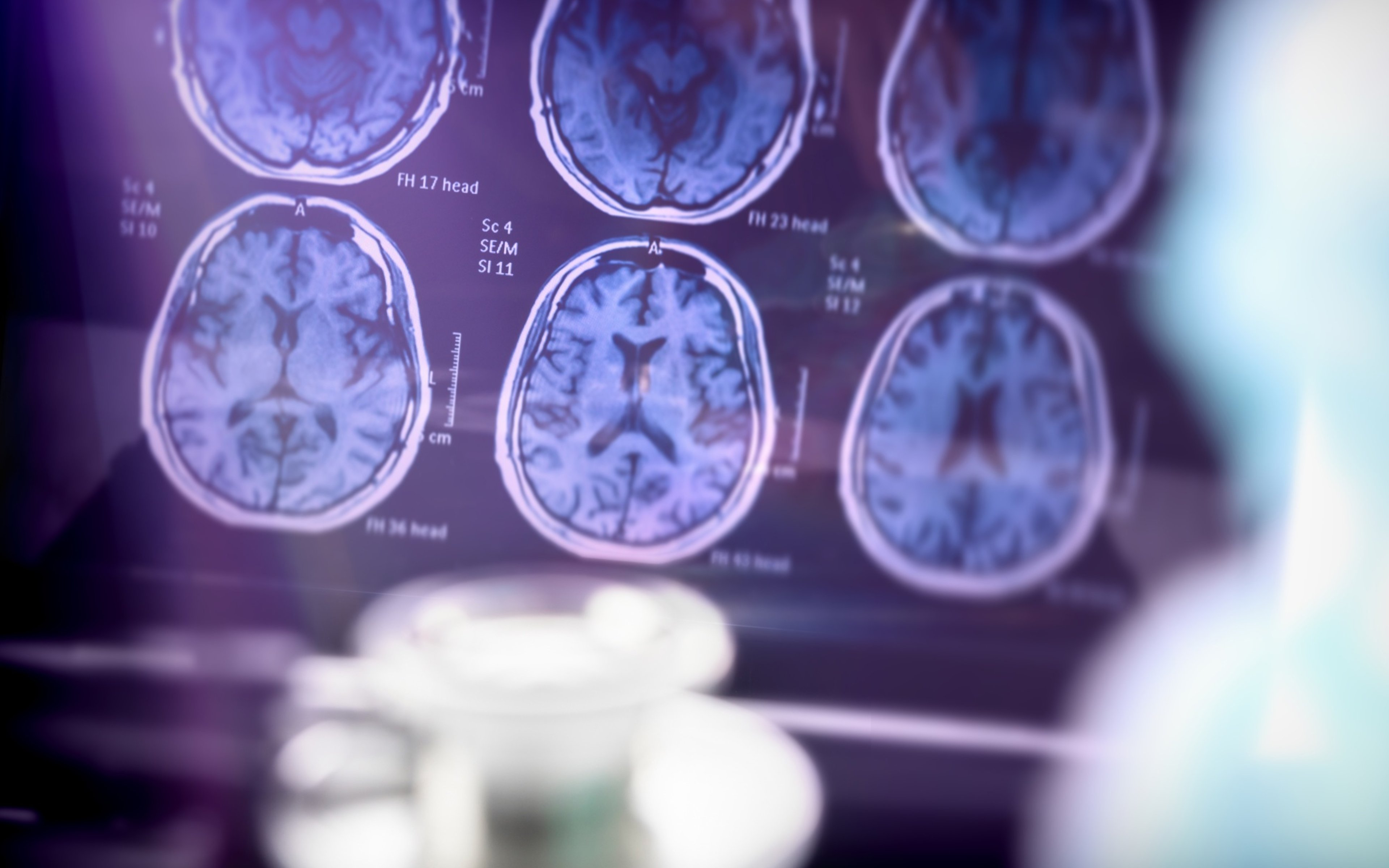 Scientific analysis of Alzheimer's disease in hospital