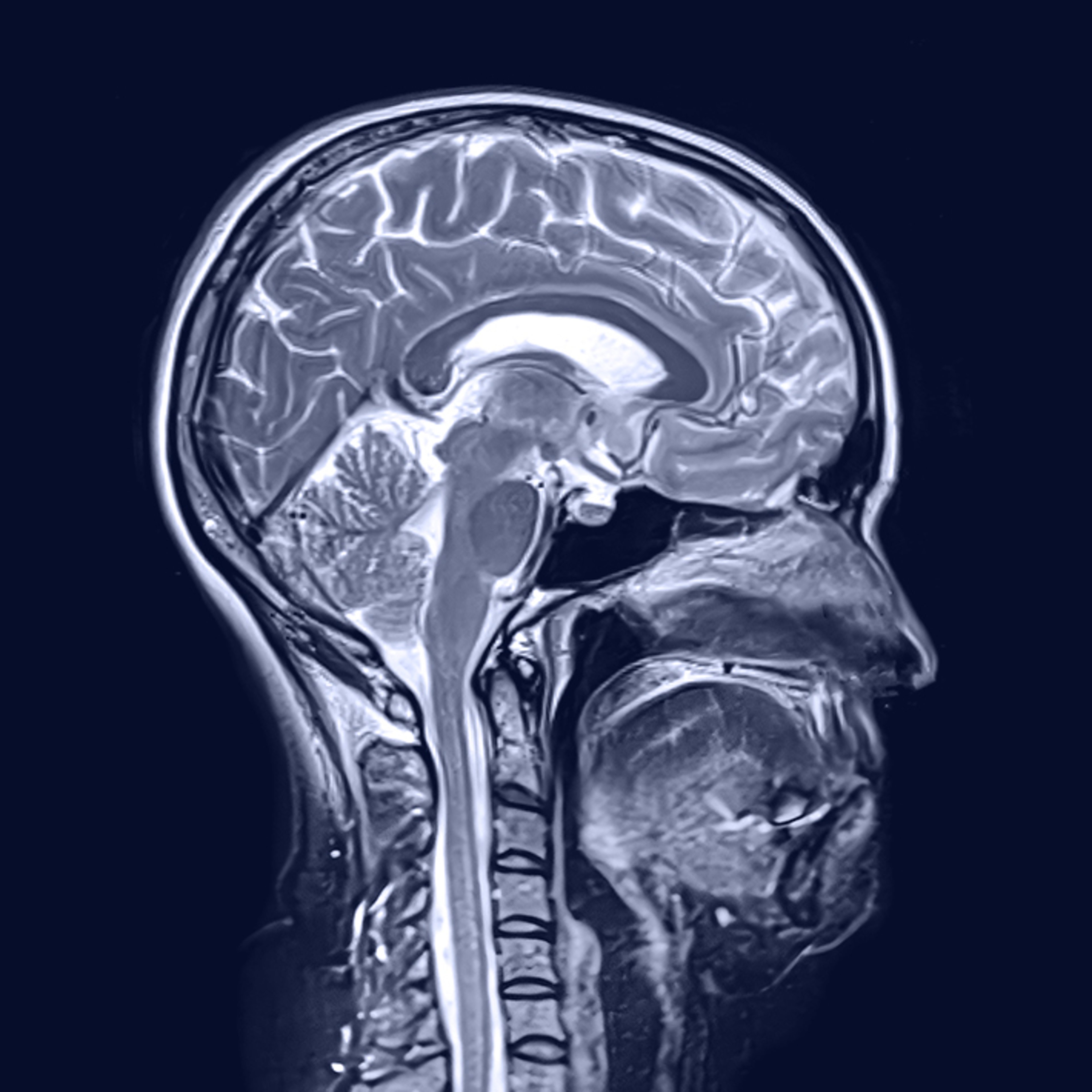 alt="Side-view MRI scan of a human head, showing detailed cross-section of the brain against a navy background"